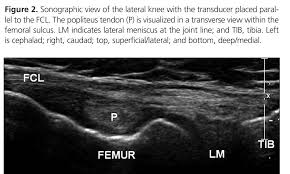 Image result for Tendon Sheath Injection