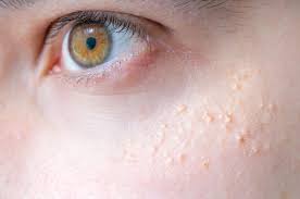 Rosacea Habitos Que Pioram O Problema E Nem Todo Mundo Se Atenta Vix