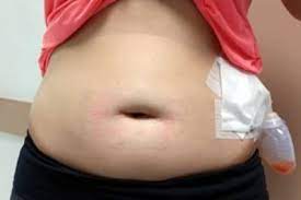 The laparoscopic approach to gastric bypass results in lower risk of wound infections and wound hernias. Gastric Sleeve Scars Guide To Reduce Scarring Quickly