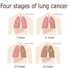 Scared i have lung cancer. Lung Cancer Treatment In India