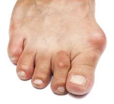 Pin On Gout