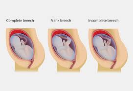 How To Turn A Breech Baby Naturally Techniques Exercises Tips