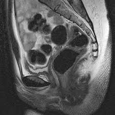 Females affected with the disorder lack normal menstrual periods and are generally unable to carry pregnancy. Mayer Rokitansky Kuster Hauser Syndrome Radiology Case Radiopaedia Org