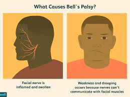 Viruses that have been linked to bell's palsy include viruses that cause: Bell S Palsy In Covid 19 Vaccine Trials What You Need To Know