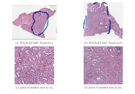 prostate cancer is the most common cancer diagnosed among american men, and causes more deaths annually among men than any other tumor except lung cancer. The Intermediate Prostate Cancer Image Examples Download Scientific Diagram