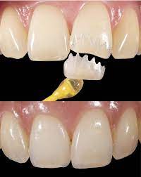 Mini Dental Veneer Dental Veneers Dental Implants Cost Dental Aesthetics