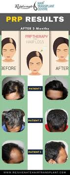16 Best Prp Hair Ideas Prp Hair Hair Loss Treatment Hair