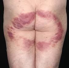 Image result for itchy skin rectum