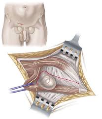 Leistenbruch Op Spezialisten Finden Leading Medicine Guide