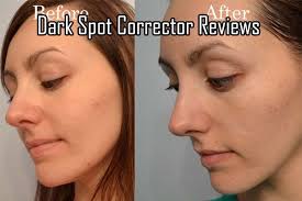 Dark Spot Corrector Reviews Dark Spot Correctors Dark Spot Corrector Best Dark Spot Corrector Dark Spots