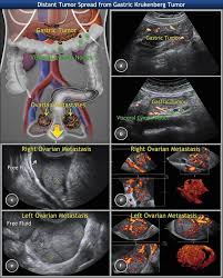 Pin On Ovarian Tumors Clinical Setting And Us