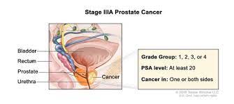 Prostate cancer staging is vital because it is used to guide the treatment plan and predict the patient's prognosis. Definition Of Stage Iii Prostate Cancer Nci Dictionary Of Cancer Terms National Cancer Institute