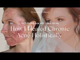 How I Healed Years of Chronic Acne Holistically with Grace Harvey and  Taylor Dukes