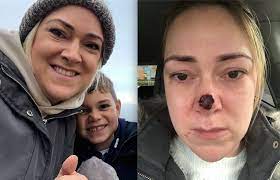 The good news is many cases of lung cancer are believed to be preventable, as an estimated 90% of lung cancer cases are caused by active smoki. Harmless Spot On Mum S Nose Turned Out To Be Skin Cancer