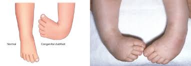Image result for Clubfoot