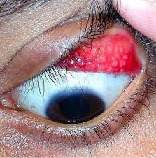 Image result for Vernal Conjunctivitis