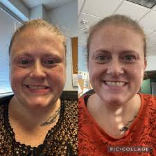 How long was you down for after surgery?