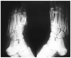 Cependant, il survient le plus. Unilateral Lytic Changes Over The Weight Bearing Joint Causing Severe Destruction Of Ankle Joint Atypical Charcot Joint In A Girl With Congenital Insensitivity To Pain Without Anhidrosis Hereditary Sensory And Autonomic Neuropathy Type