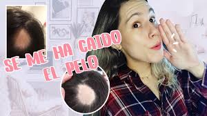 Mi Experiencia con la ALOPECIA AREATA 😱| Alopecia Mujeres