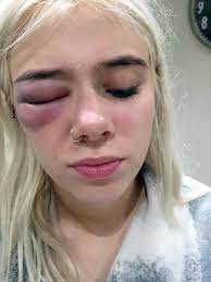 Yorkshire Teenager S Allergic Reaction Ravages Her Face