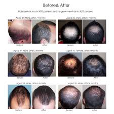 After a few months with some first signs of new hair growth, your hair will become bulky and strong. Hair Growth Laser Cap For Men And Women Hair Growth Helmet Laser Hair Regrowth Comb Scalp Care Hair Inhibitor Anti Hair Loss Aliexpress