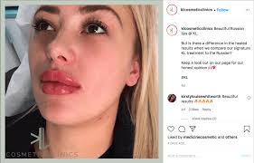 At two weeks, there's generally no swelling. Russian Lips The Trending Lip Filler Technique Kl Cosmetics Clinic Doncaster Kl Cosmetics Clinic Doncaster