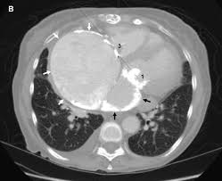 Image result for XRay Changes in Rheumatic Conditions