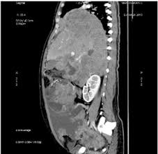 Because adequate cytoreduction is necessary to achieve prolonged survival, ct scans became an accurate prognostic radiologic test for patient selection for comprehensive treatment. Peritoneal Mesothelioma A Rare Varient