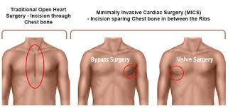 Pin On Heart Bypass Surgery