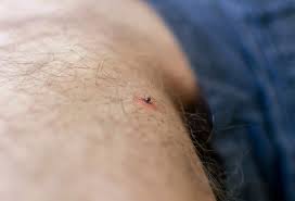 Image result for infected tick bite