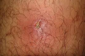 Place the compress over the boil, and leave it there for 7 to 10. Cyst Vs Boil Identification Symptoms Causes And Treatments