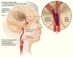 Hemorrhagic strokes (intracerebral and subarachnoid hemorrhage). 2 Types Of Stroke Atrain Education