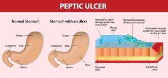7 Symptoms Of Stomach Ulcer In Children And Its Treatment