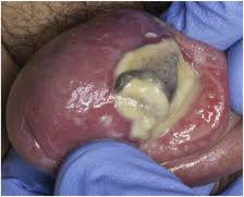 Image result for penis mycosis symptoms