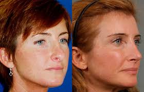 Fraxel Laser Newburgh, NY