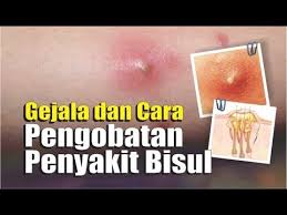 Gejala Dan Cara Pengobatan Penyakit Bisul Youtube