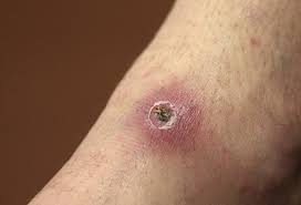 Eschar is a collection of dead tissue within the. Clinical Image Of A Typical Eschar At The Site Of A Tick Bite Download Scientific Diagram