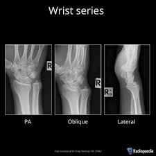 Navicular bone coffin bone/p3 vascular channels solar margin semilunar canal wings of the coffin bone. Wrist Series Radiology Reference Article Radiopaedia Org