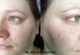 The Ordinary Aha 30 Bha 2 Peeling Solution The Ordinary Aha 30 The Ordinary Before And After The Ordinary Bha