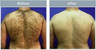 Hair removal hair stylists barbers. Laser Hair Remoal Jyothi Puram Md Springfield Dayton Columbus Ohio Med Spa Zeltiq Coolsculpting Internal Medicine