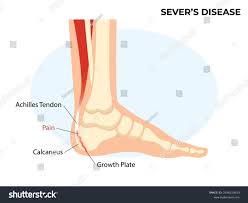 Image result for Calcaneal Apophysitis