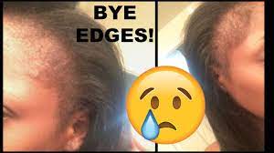 Alright, i'm pretty convinced got2b glued spiking glue is causing hair loss. I M Bald Edgeless Got2b Glued Snatched My Edges Don T Use Youtube