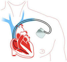 A machine that uses an electric current to stop any irregular and dangerous activity of the…. Defibrillator Icd Deutschland E V