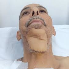 PDF) Cervicofacial Defect Reconstruction Using Deltopectoral Flap