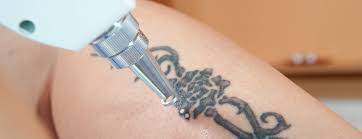 Tattoos may be lightened but cannot be completely removed. Laser Tattoo Removal Conditions Treatments Ucsf Health