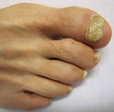 Image result for Onychogryphosis feet