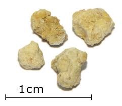 Image result for Sialolithiasis