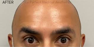 10380 foothill blvd, rancho cucamonga ca 91730. Before And After Photos Brea Plastic Surgery Gallery Costa Mesa Skin Perfect Medical