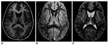Case 6 Juvenile Huntington Disease The Patient Is An 8 Year Old Boy Download Scientific Diagram
