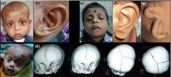 Intellectual disability is a term used when a person has certain limitations in mental functioning and in skills such as communicating, taking care of him or herself, and social skills. Phenotypic Characterization Of Derivative 22 Syndrome Case Series And Review Springerlink
